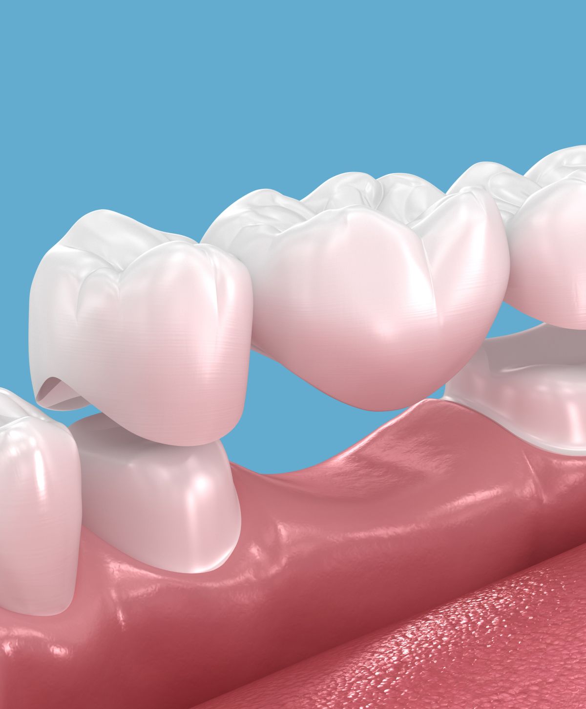 dental bridge graphic