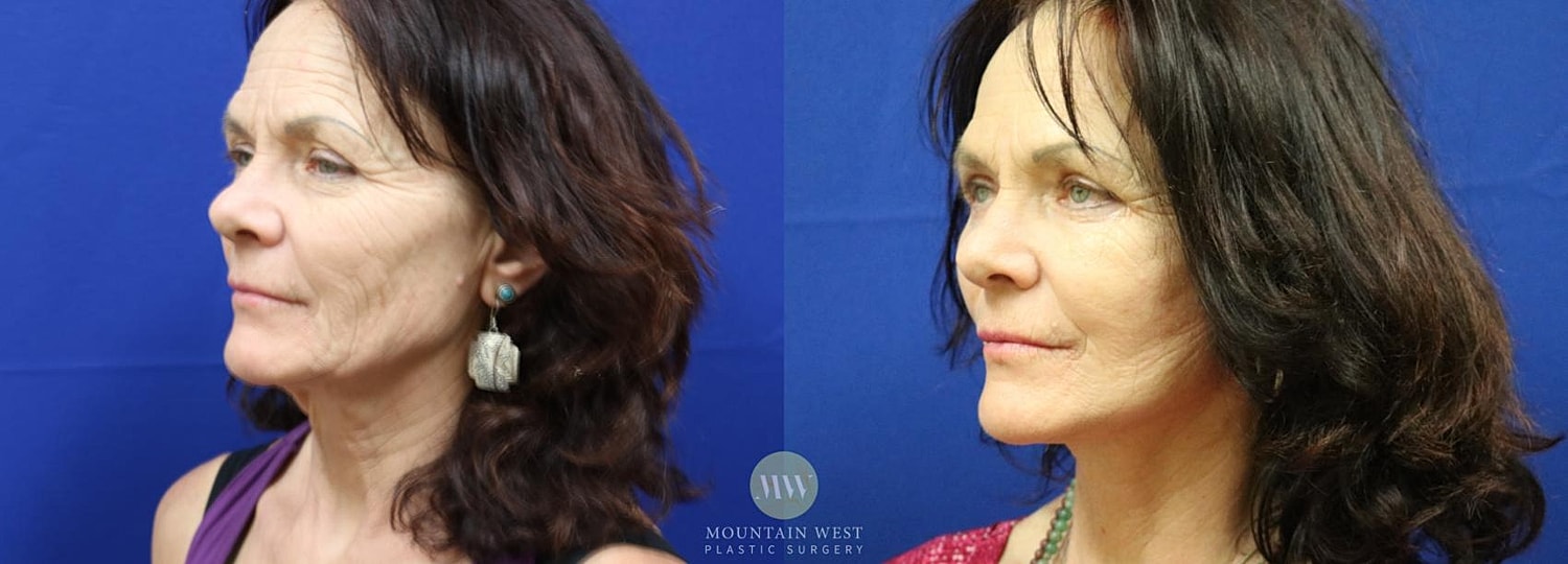 facelift before and after