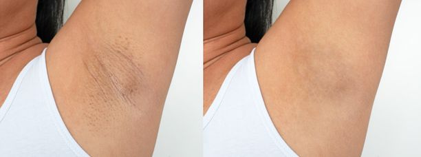 Arms Before & After before and after hair removal on armpit's