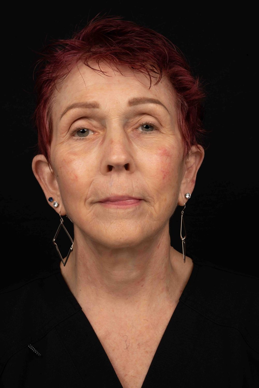 face/neck patient before & After