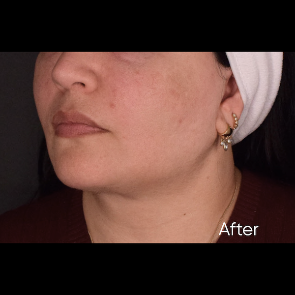 facelift before & after photo