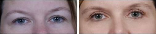 blepharoplasty patient 10 before and after