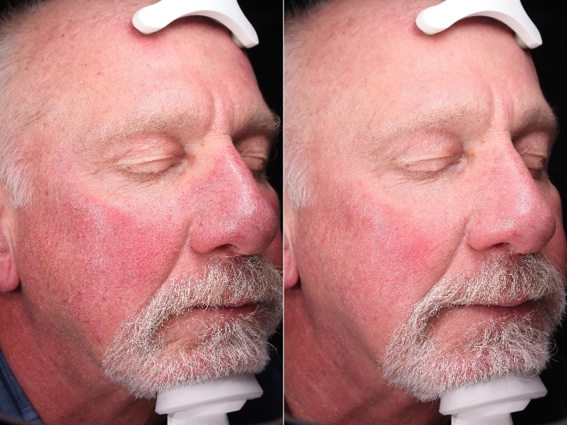 bbl before and after