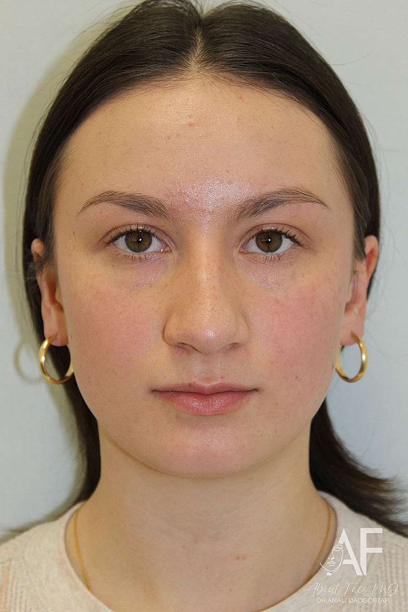 rhinoplasty before and after