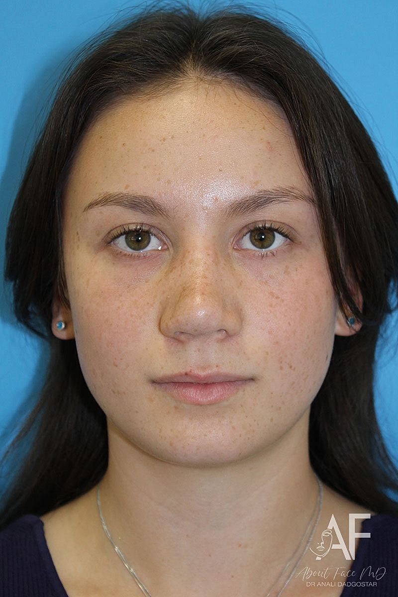 rhinoplasty before and after