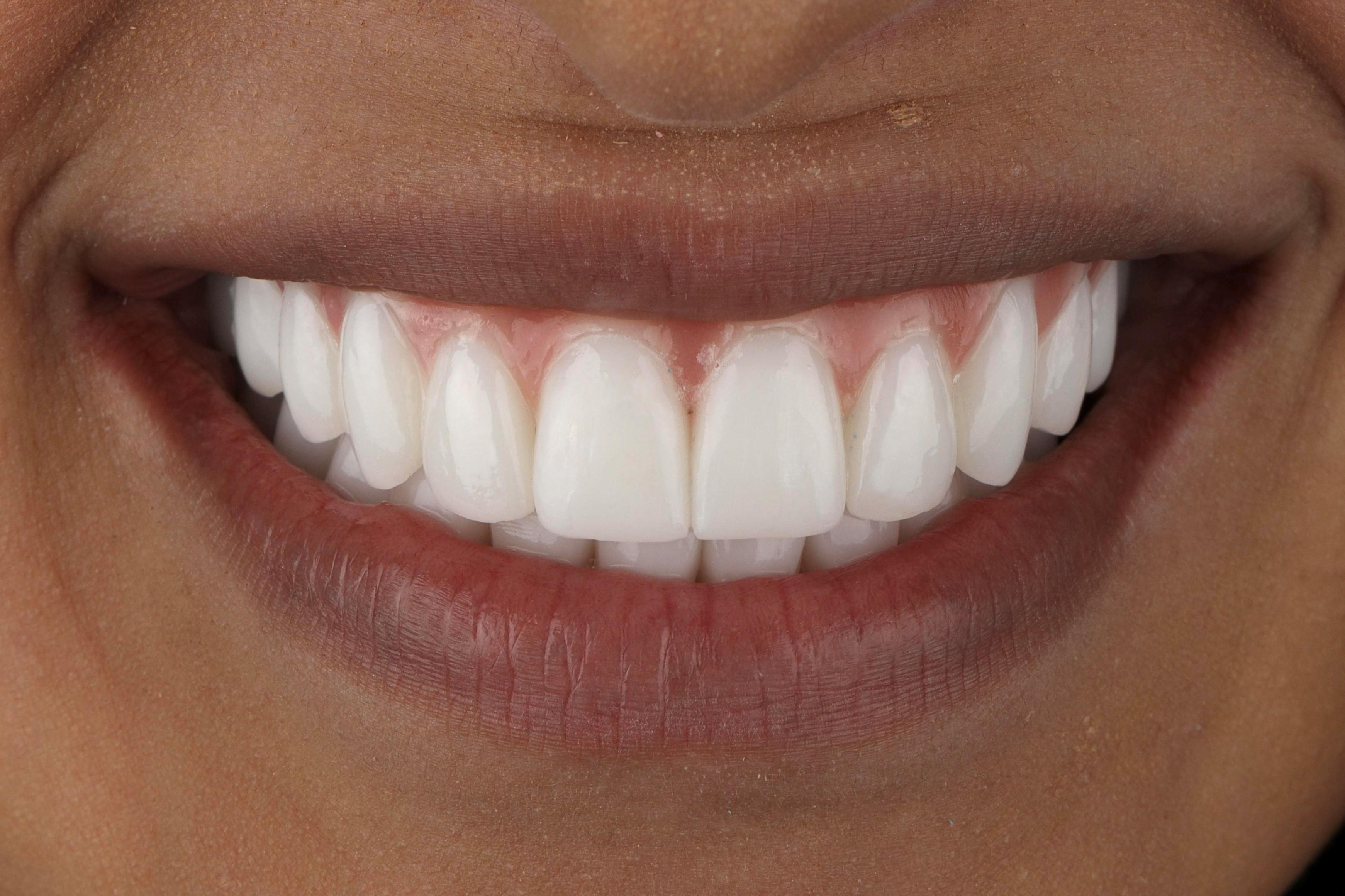 dental implants patient after