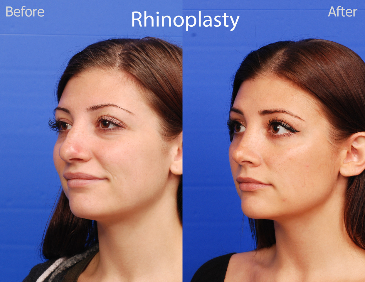 rhinoplasty before and after