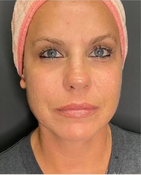 rf microneedling patient 4 after