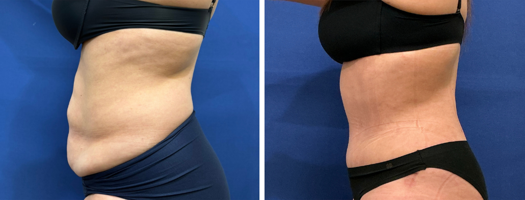 stomach tuck surgery patient 4 before & after