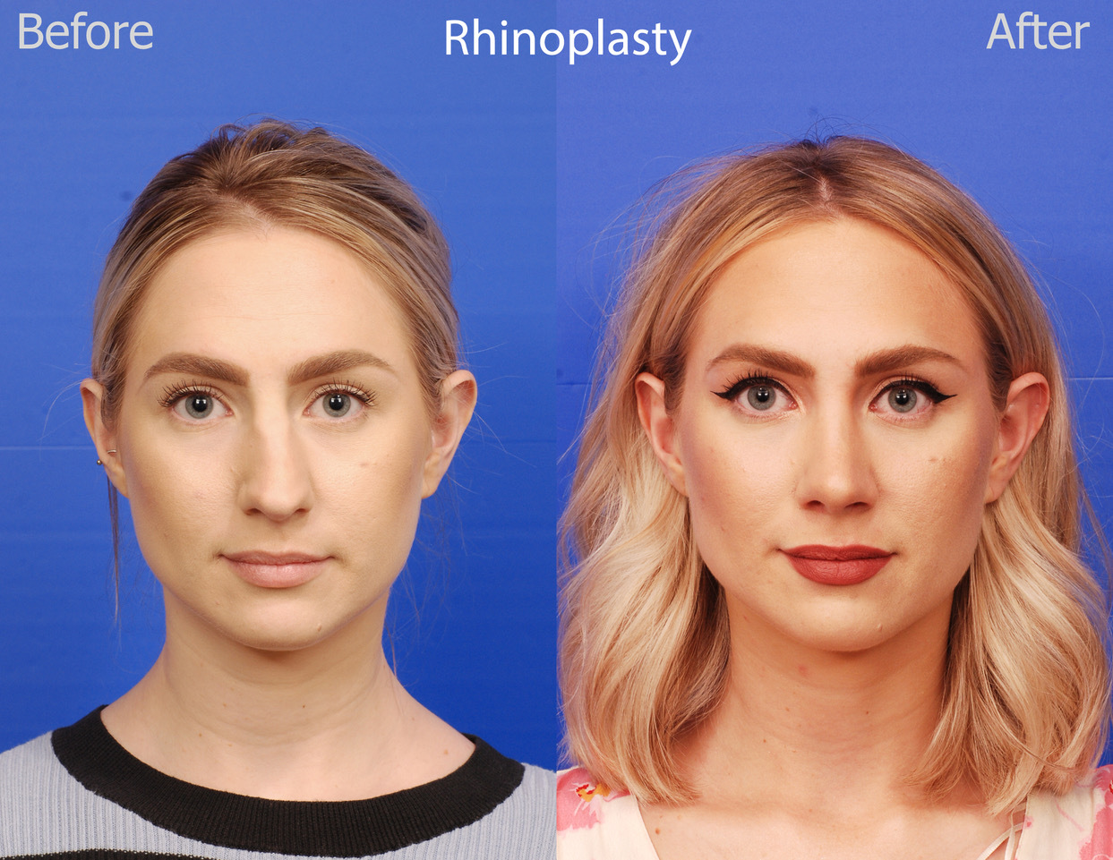 rhinoplasty before and after