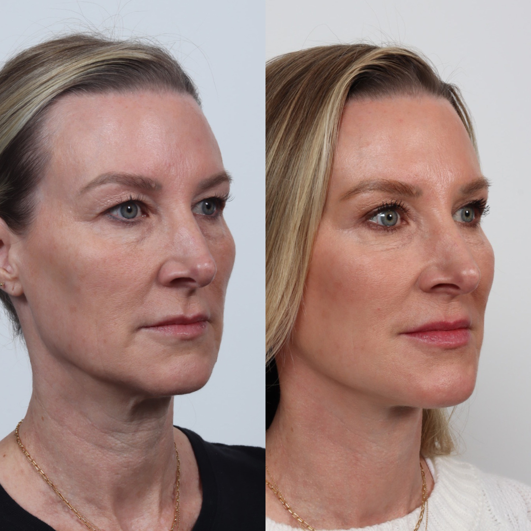 facelift patient #1 before and after