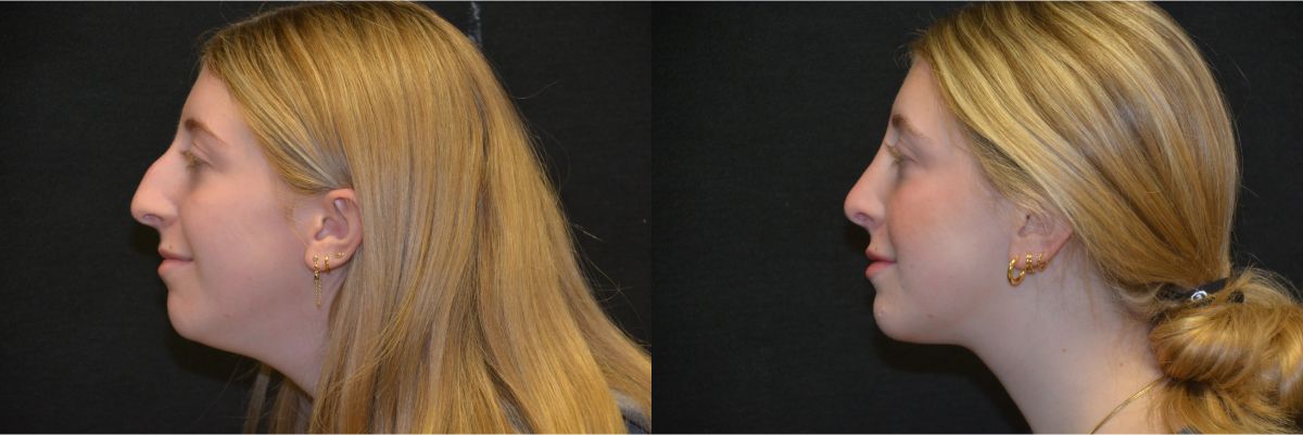rhinoplasty before and after patient 1