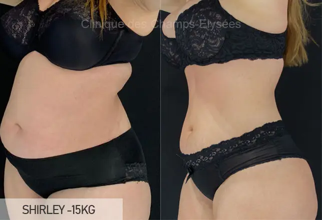 Avant/Apr&egrave;s traitement capillaire