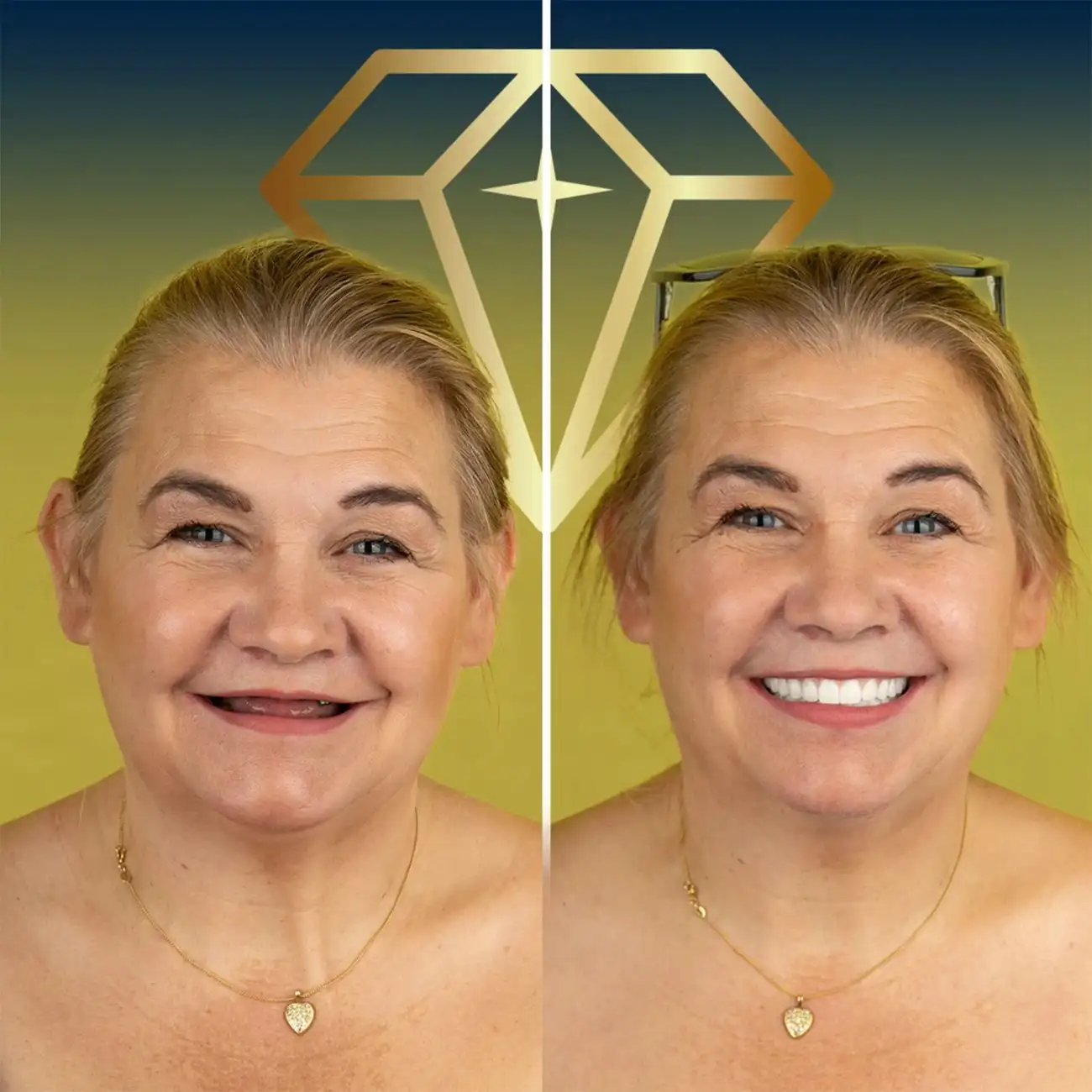 alt="Before and after dental implants transformation at Kristal Clinic"