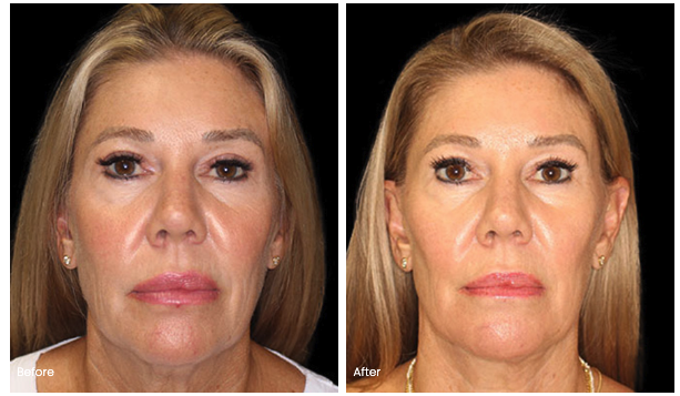 deep plane facelift before and after