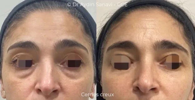 Avant/Après traitement capillaire