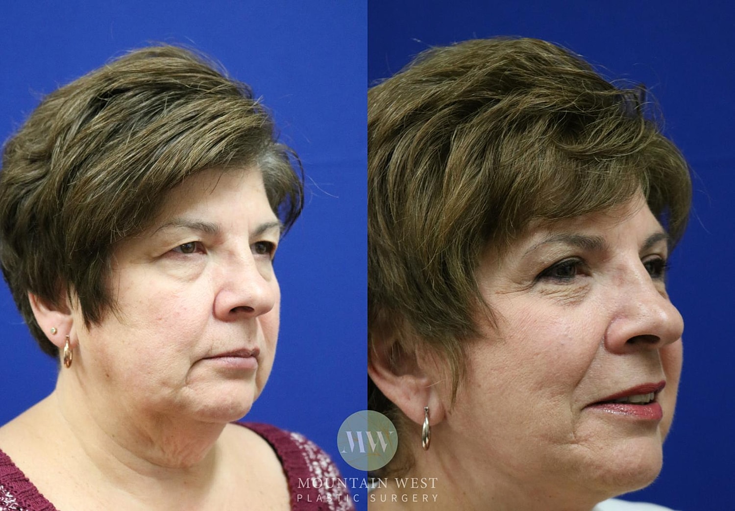 facelift before and after