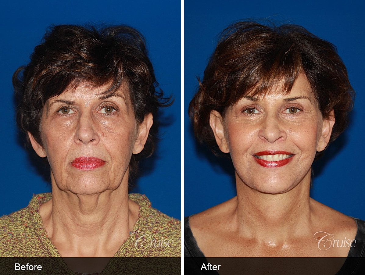 facelift before and after