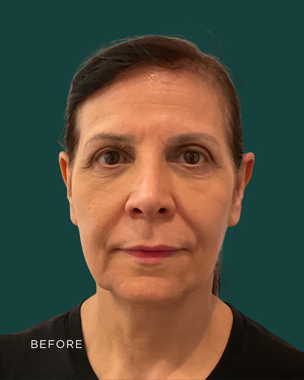 facelift before & after photo
