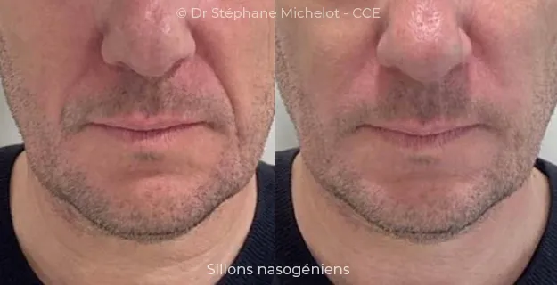 Avant/Après traitement capillaire