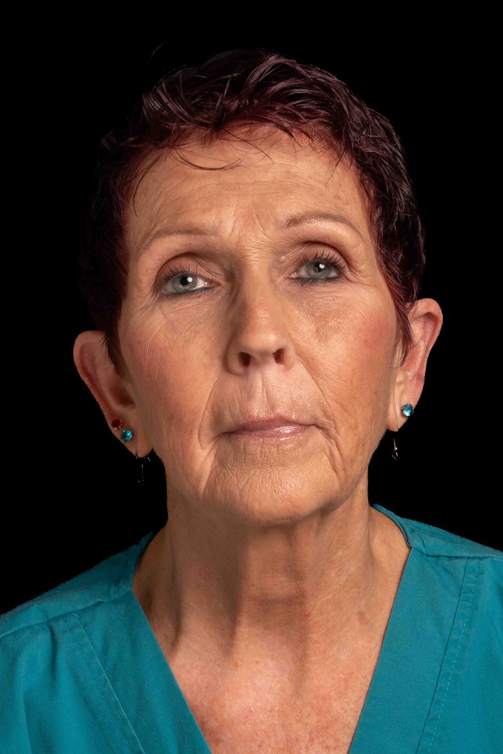 face/neck patient before & After