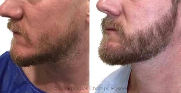 Avant/Après traitement capillaire