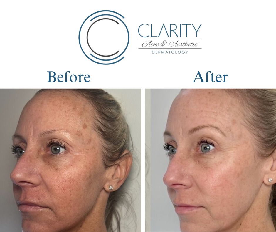 before and after results