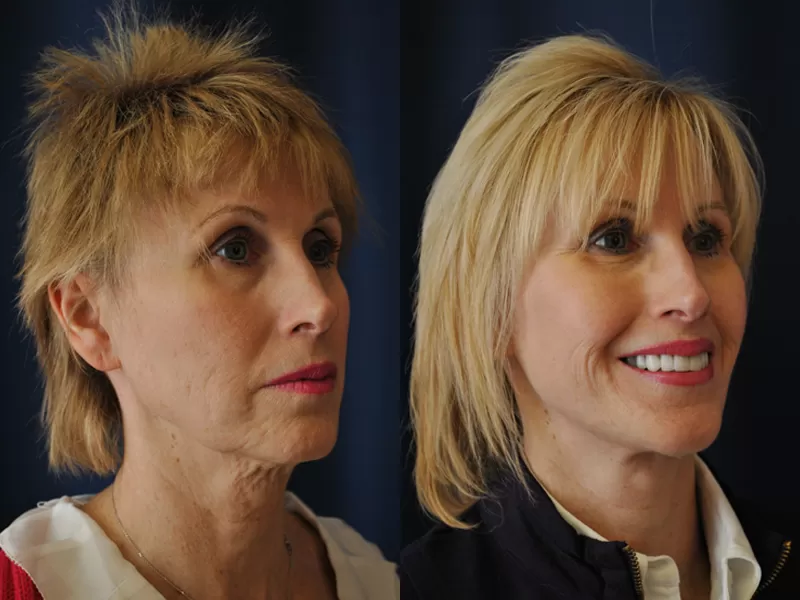 facelift and neck lift before & after