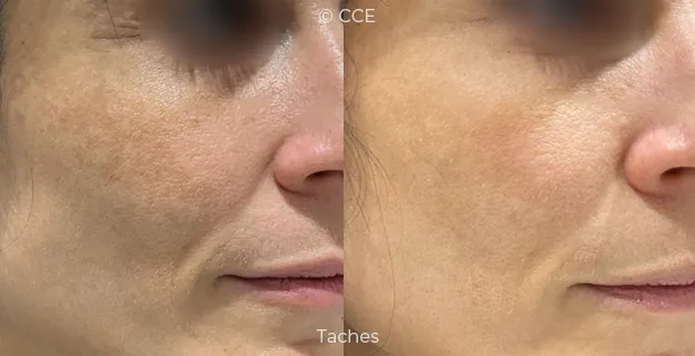 Avant/Après traitement capillaire