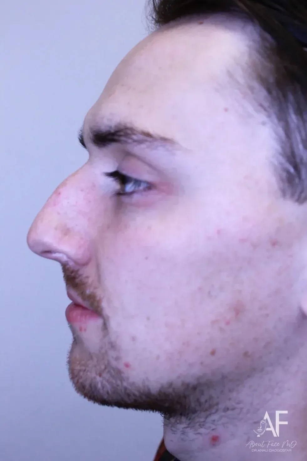 rhinoplasty before and after