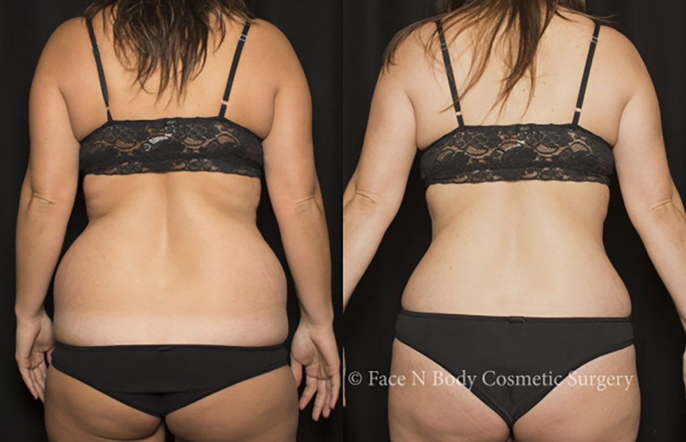 liposuction before and after