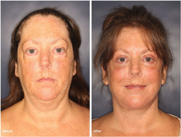 NECKLIFT BEFORE & AFTER