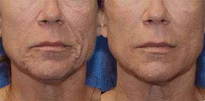 microneedling results