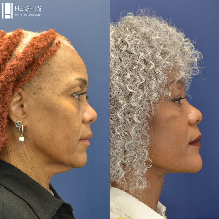 Facelift Before & after