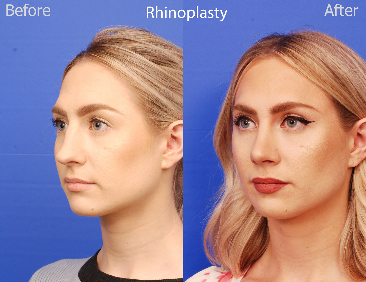 rhinoplasty before and after