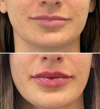 lip fillers results