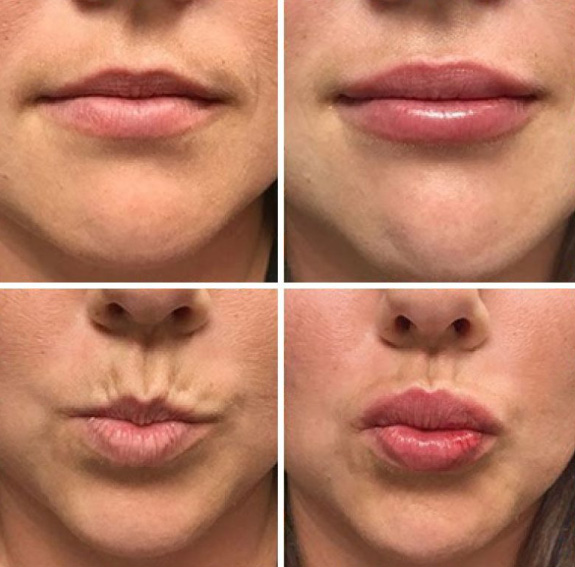 lip fillers results