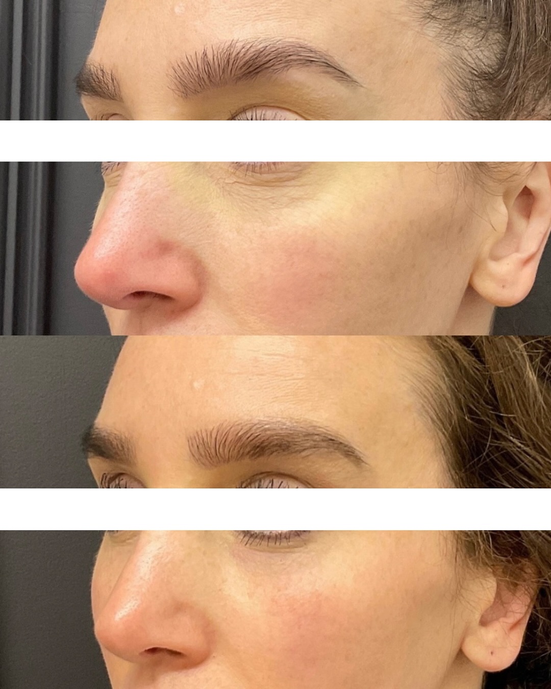 morpheus8 patient 3 before and after