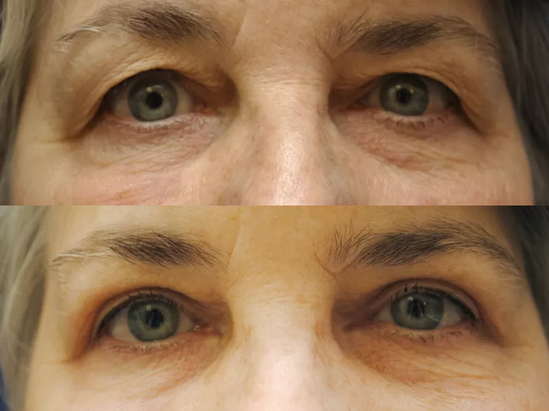 blepharoplasty before & after