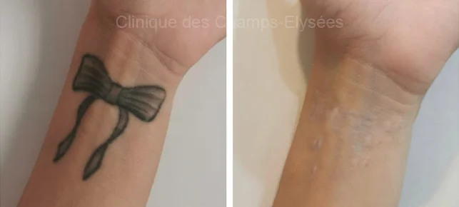 Avant/Après traitement capillaire