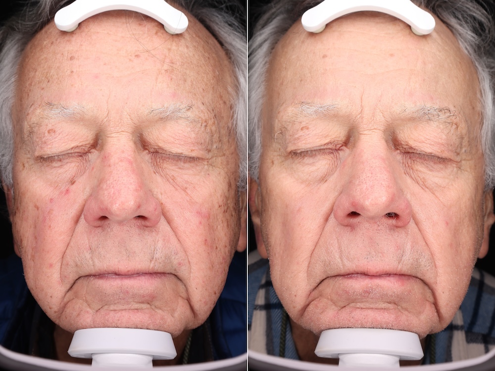 halo + bbl before and after