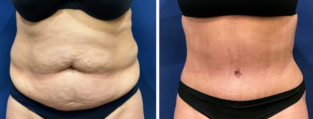 stomach tuck surgery patient 4 before & after