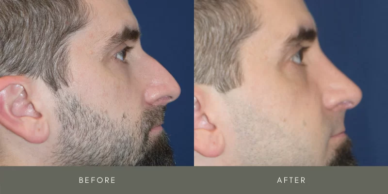 rhinoplasty before & after