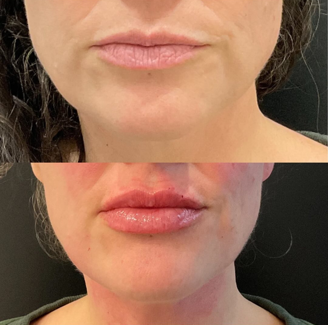 lip filler patient 6 before & after