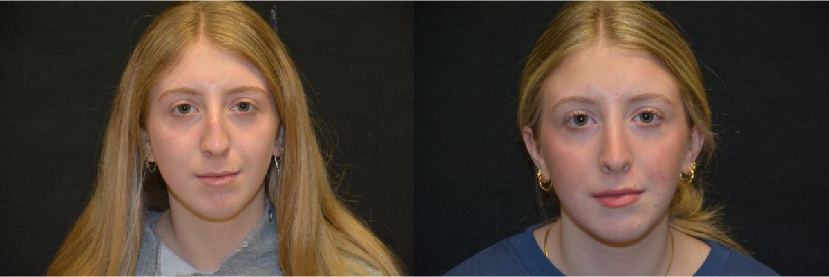 rhinoplasty before and after patient 1