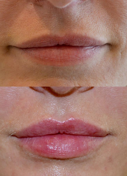 lip fillers results