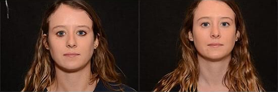 rhinoplasty before and after patient 4