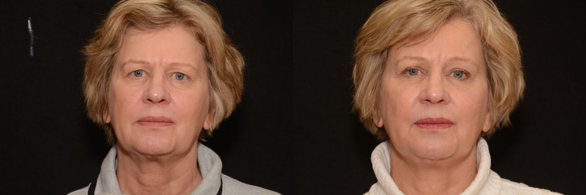 blepharoplasty patient 1 before and after