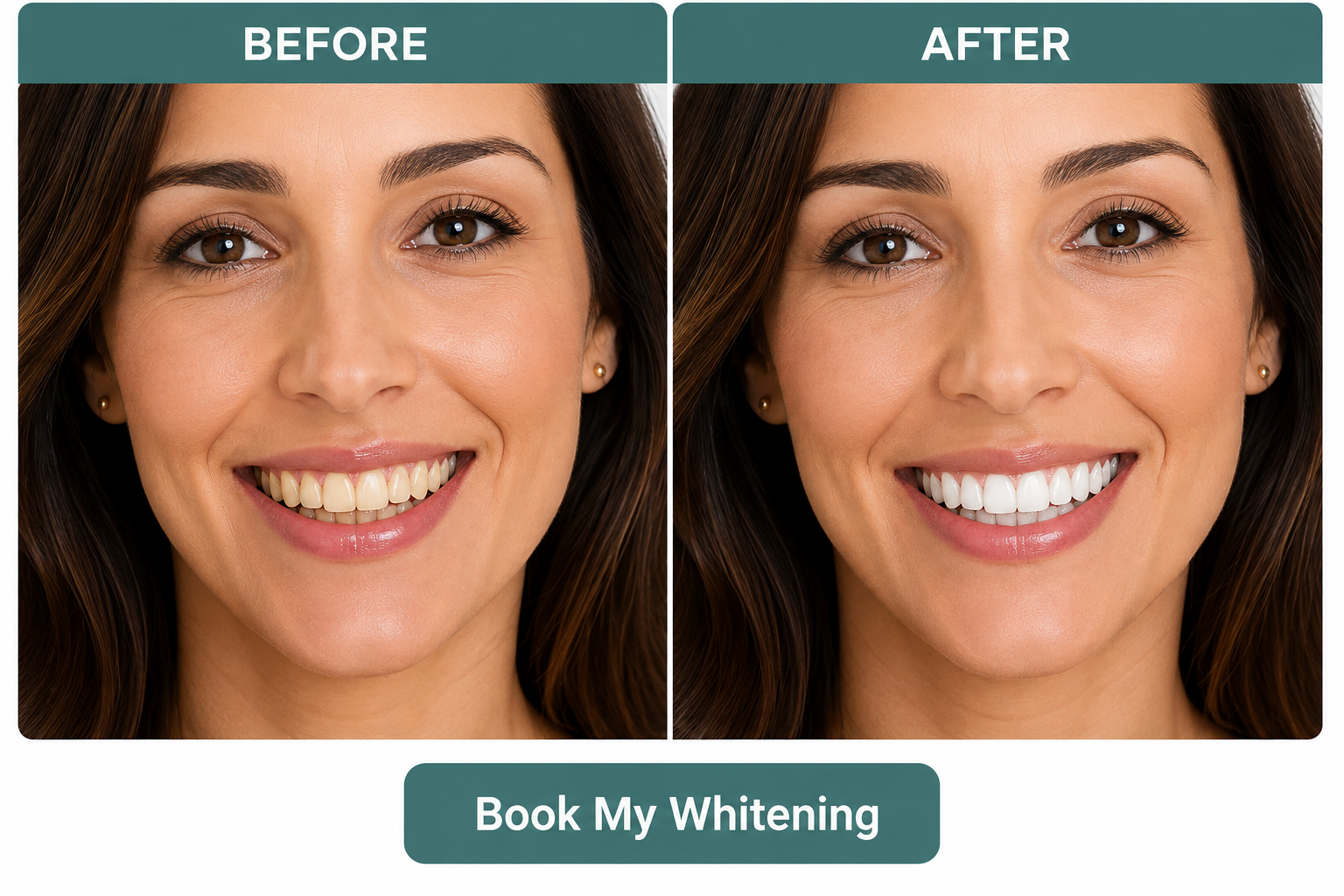 Before and after teeth whitening result showing dramatically brighter smile