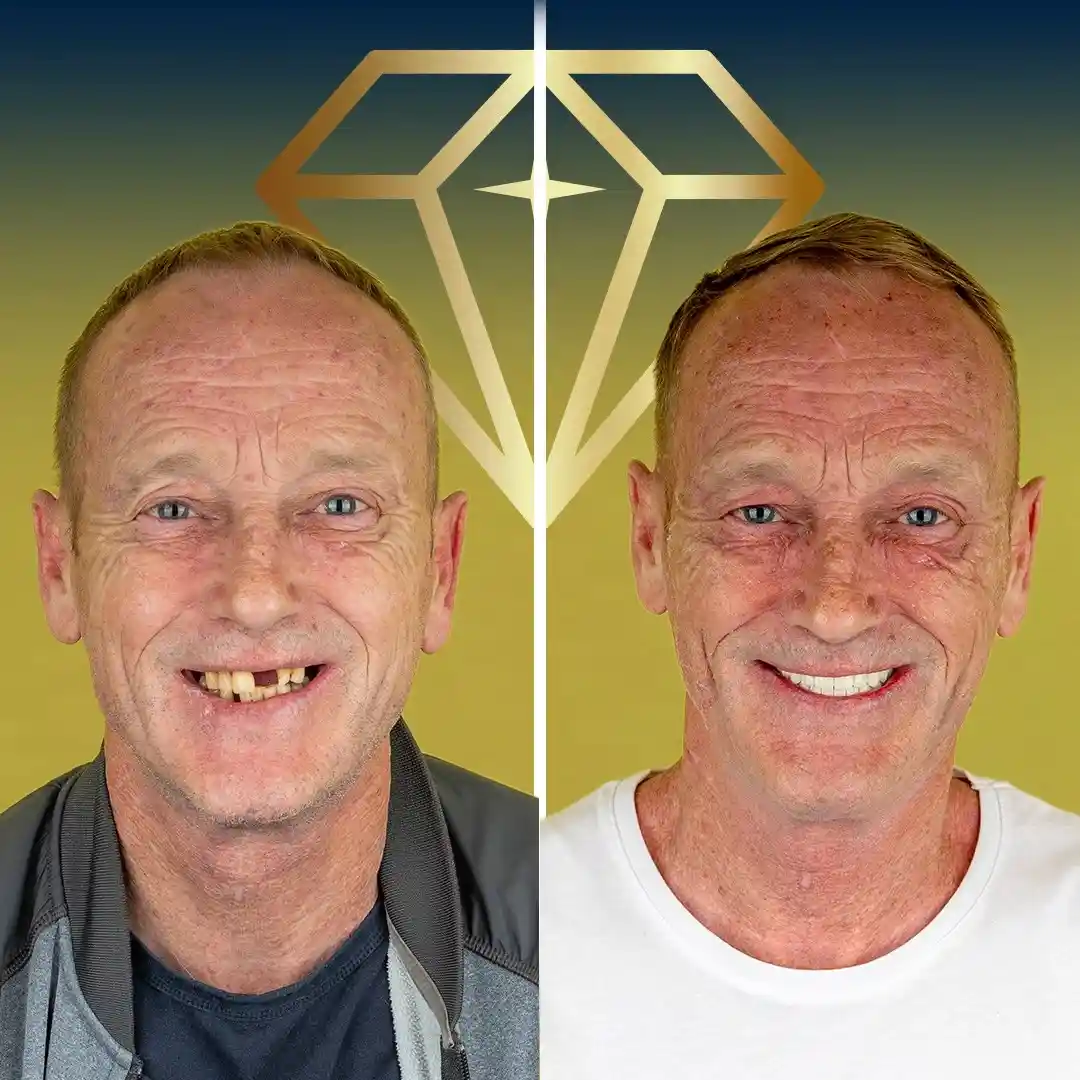 alt="Before and after dental implants transformation at Kristal Clinic"